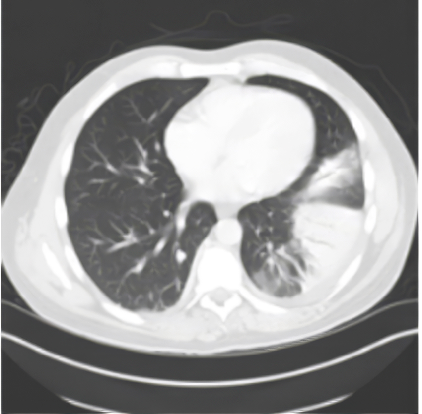 X-RAY