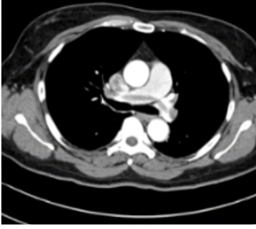 X-RAY