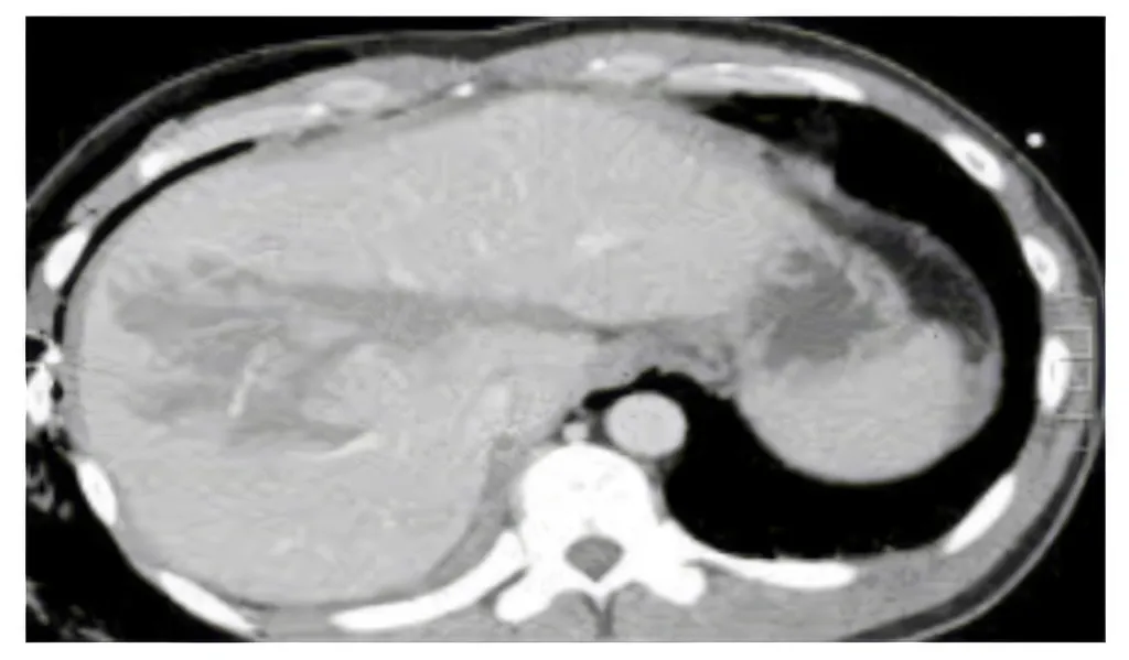 Gallbladder