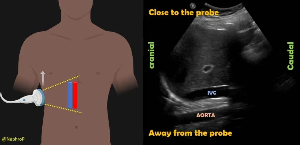 Diagram for Cardiology Subxiphoid procedure.
